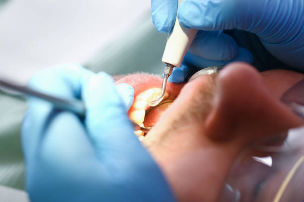 Best Emergency Wisdom Teeth Removal in Cameron Park, TX