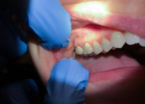 Best Emergency Denture Repair in Cameron Park, TX